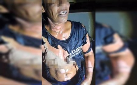 Mulher é vítima de tentativa de feminicídio: “Ele tacou fogo em mim”