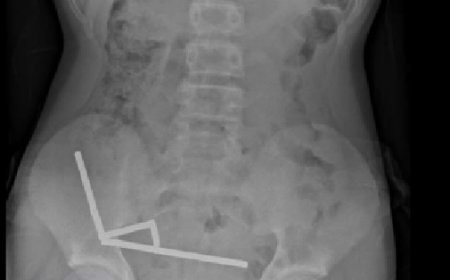 Adolescente perde parte do intestino após engolir mais de 80 imãs