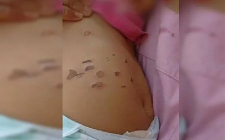 Bebê de 10 meses é queimada com cigarros na barriga e nas pernas