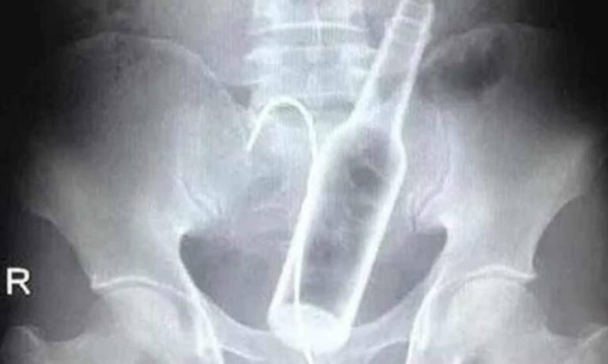 Homem passa por cirurgia após introduzir duas garrafas no ânus