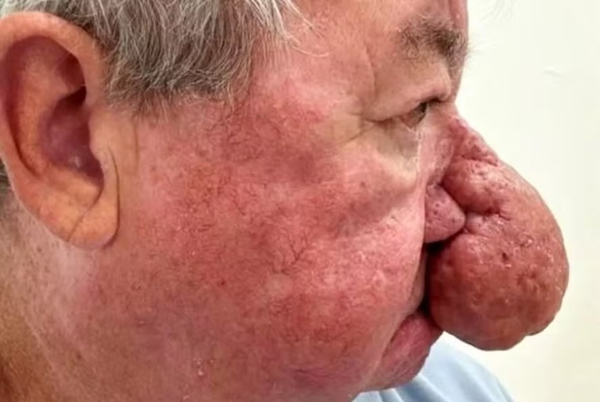 Homem com nariz gigantesco faz cirurgia para poder voltar a beijar a esposa