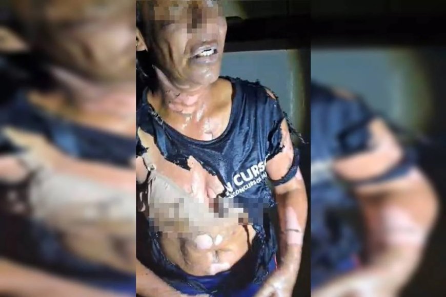 Mulher é vítima de tentativa de feminicídio: “Ele tacou fogo em mim”