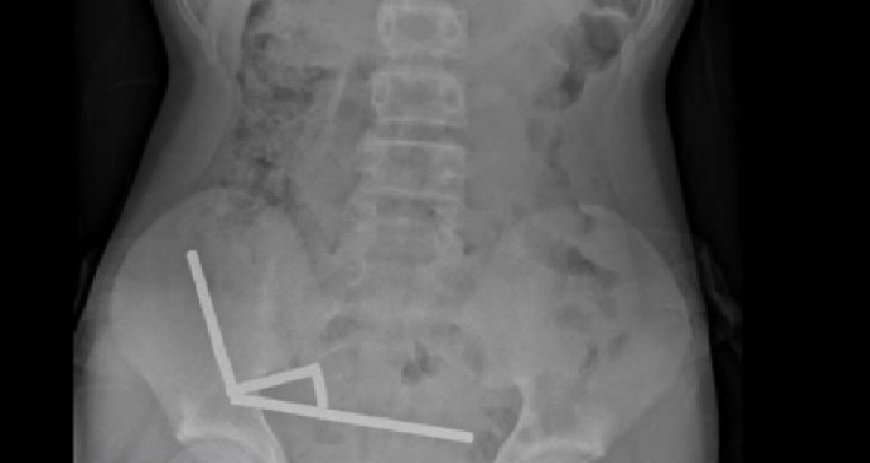 Adolescente perde parte do intestino após engolir mais de 80 imãs