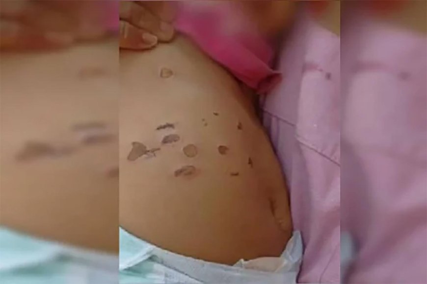 Bebê de 10 meses é queimada com cigarros na barriga e nas pernas