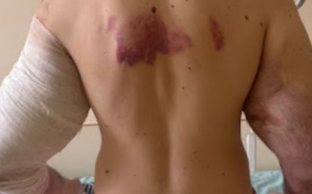 Influenciador pode perder os braços após injetar óleo nos bíceps