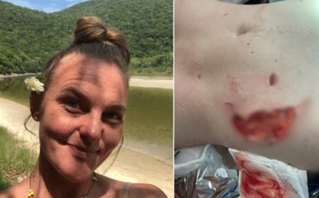 “Dor violenta”: Mulher é atacada por capivara e tem parte de nádega arrancada