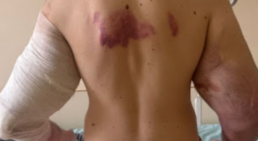 Influenciador pode perder os braços após injetar óleo nos bíceps