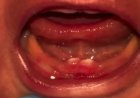 Bebê de Rondônia nasce com dentes e passa por cirurgia para retirá-los