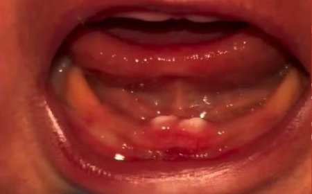 Bebê de Rondônia nasce com dentes e passa por cirurgia para retirá-los