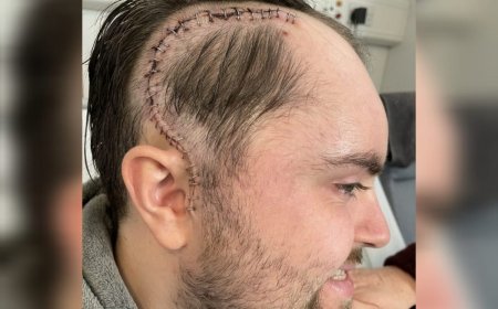 Homem ignora sinais de tumor no cérebro achando ser dor de musculação