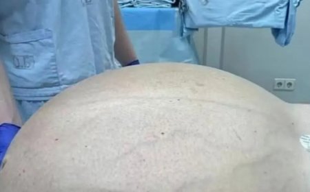 Médicos retiram tumor de quase 60 kg de paciente com 50 anos