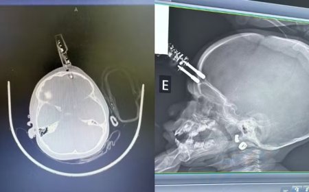 Bebê deverá ter acompanhamento médico contínuo após ter carregador de celular cravado na testa