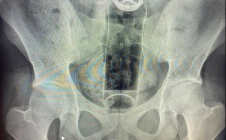 Paciente é internado após ficar com desodorante preso no reto; médicos fazem alerta