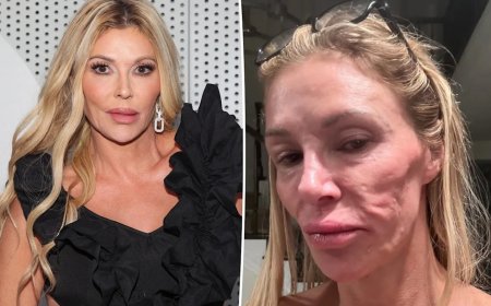 Influenciadora mostra resultado de cirurgia após rosto “derreter”