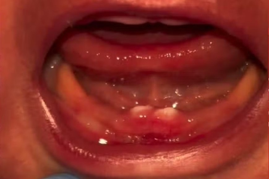 Bebê de Rondônia nasce com dentes e passa por cirurgia para retirá-los
