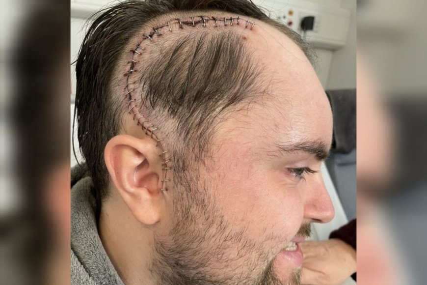 Homem ignora sinais de tumor no cérebro achando ser dor de musculação