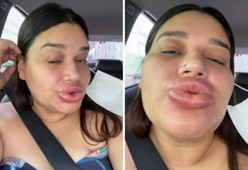 Maquiadora fica com lábios gigantes após retirar preenchimento e viraliza ao rir da situação: 'Lindíssima'