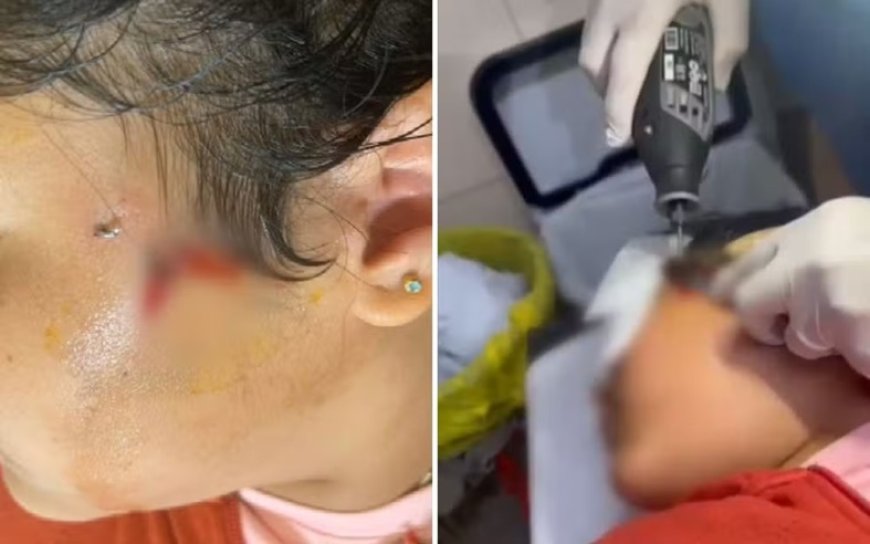 Criança de 10 anos fica com anzol preso ao rosto durante pescaria