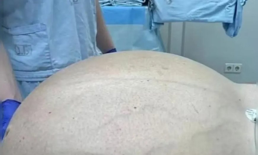 Médicos retiram tumor de quase 60 kg de paciente com 50 anos