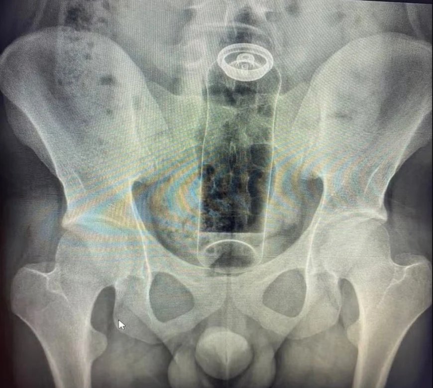 Paciente é internado após ficar com desodorante preso no reto; médicos fazem alerta