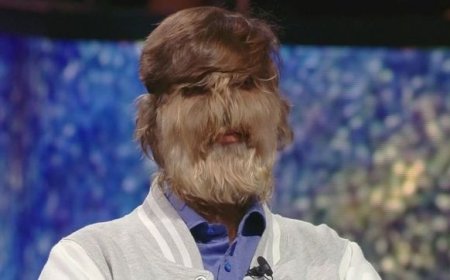 Homem com síndrome do lobisomem vira fenômeno na internet