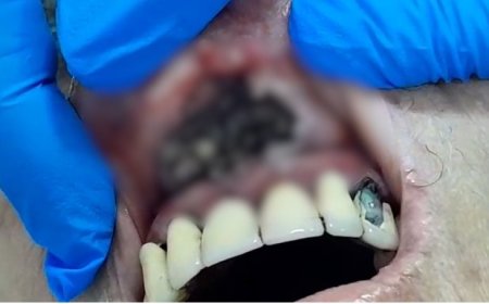 CENA DE TERROR: Idosa é resgatada com larvas na boca e morre após dias internada