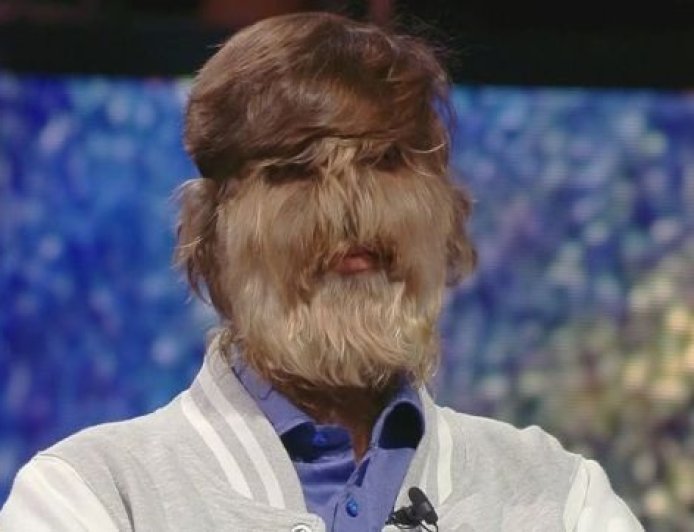 Homem com síndrome do lobisomem vira fenômeno na internet