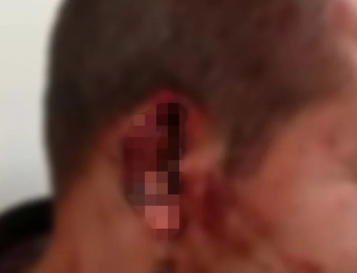 Mulher acusada de arrancar orelha de homem e jogar no lixo é presa