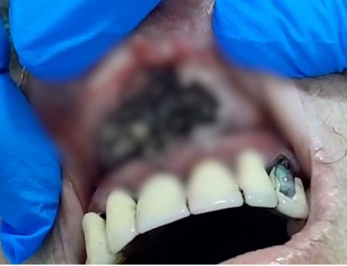 CENA DE TERROR: Idosa é resgatada com larvas na boca e morre após dias internada