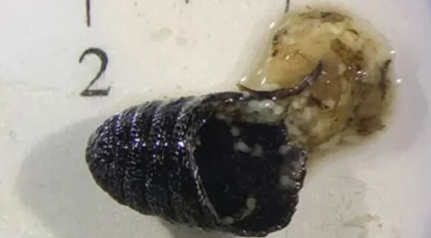 Terror Médico: Mulher espirra "vermes" e médicos descobrem ninho de larvas em seu rosto