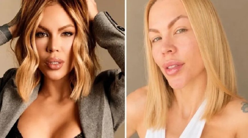 "Gastei mais de R$ 100 mil tentando desfazer meu rosto": influenciadora revela reversão estética