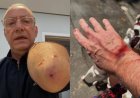 Apresentador da Globo é atacado por pitbull e mostra ferimentos