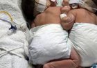 Nascidos unidos pelo abdômen, gêmeos siameses morrem em Goiânia