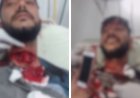 Motociclista sobrevive a corte profundo de cerol e choca a internet ao sorrir durante a cirurgia