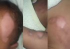 Bebê de 9 meses sofre queimaduras graves durante banho em creche e vai para cirurgia