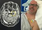 Homem confunde sintomas com efeito de parar de beber e descobre tumor cerebral agressivo