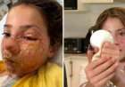 Desafio viral termina em tragédia: Squishy aquecido explode e desfigura criança de 10 anos