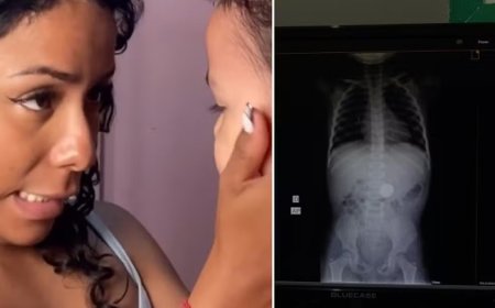 Mãe se choca após filha revelar o que engoliu, e raio-X confirma