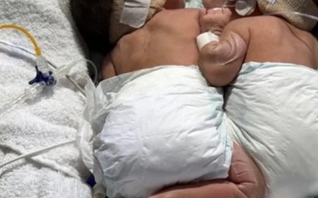 Nascidos unidos pelo abdômen, gêmeos siameses morrem em Goiânia