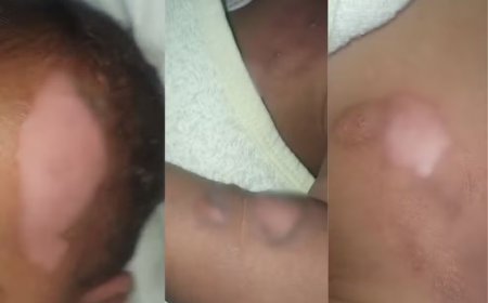 Bebê de 9 meses sofre queimaduras graves durante banho em creche e vai para cirurgia