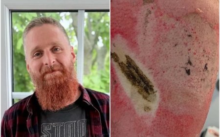 Homem sofre queimadura grave após bateria de vape explodir em bolso