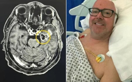 Homem confunde sintomas com efeito de parar de beber e descobre tumor cerebral agressivo