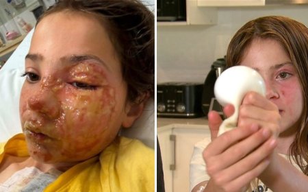 Desafio viral termina em tragédia: Squishy aquecido explode e desfigura criança de 10 anos