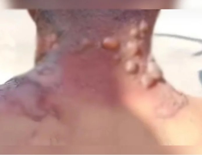 IMAGENS FORTES!! Homem acusa namorada de mantê-lo em cárcere e queimá-lo com água fervente