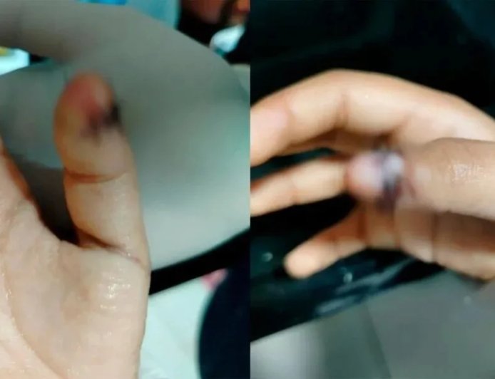Menino autista tem dedo esmagado na porta da escola e família denuncia