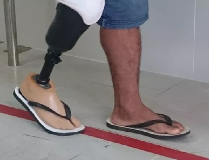 Homem é preso após amputar o pé para receber seguro de R$ 1,5 milhão