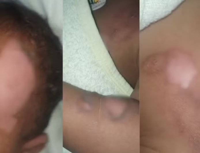 Bebê de 9 meses sofre queimaduras graves durante banho em creche e vai para cirurgia
