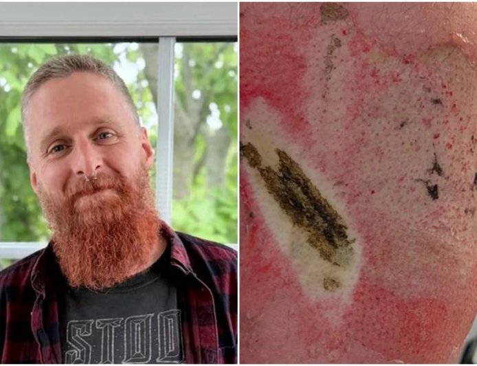 Homem sofre queimadura grave após bateria de vape explodir em bolso