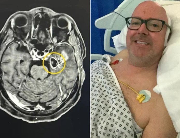 Homem confunde sintomas com efeito de parar de beber e descobre tumor cerebral agressivo