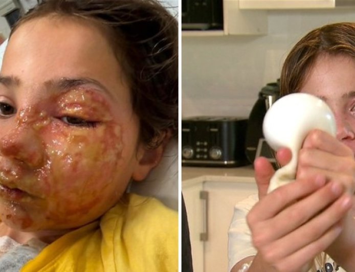 Desafio viral termina em tragédia: Squishy aquecido explode e desfigura criança de 10 anos